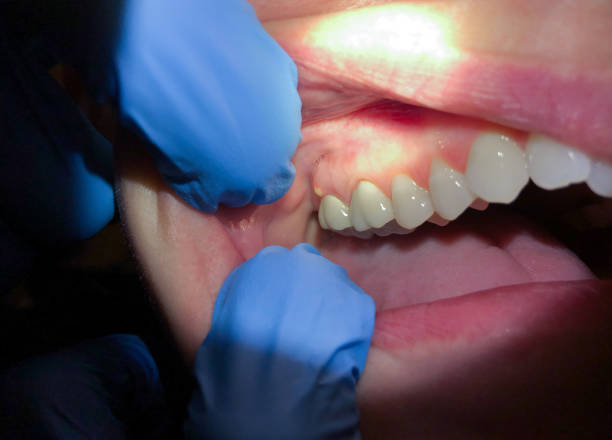 Best Emergency Dental Care for Broken or Chipped Teeth in Everett, PA
